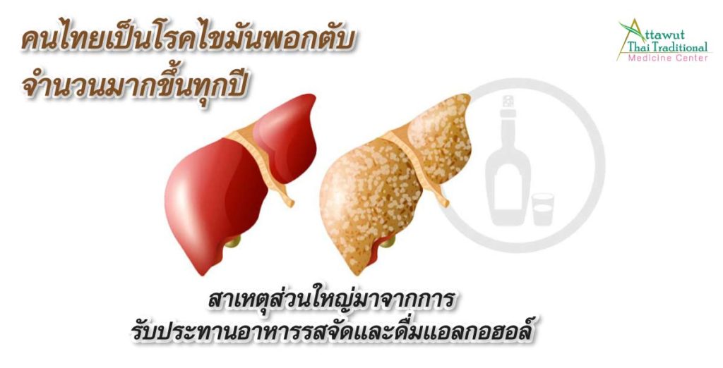 คนไทยเป็นโรคไขมันพอกตับจำนวนมากขึ้นทุกปี สาเหตุส่วนใหญ่มาจากการรับประทานอาหารรสจัดและดื่มแอลกอฮอล์